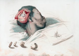 Ansicht der Wunde im Schädel nach Trepanation und Entfernung des zersplitterten Knochens unten links, 1821 von Thomas Landseer