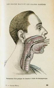 Verwendung eines Laryngoskops zur Entfernung eines Polypen aus dem Hals, ca. 1890