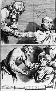 Blutung und Nasendusche von Johannes Sculpteti „Armamentarium Surgery“ Amsterdam 1672
