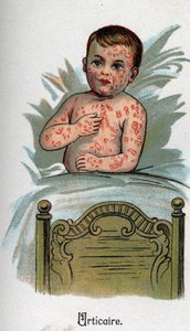 Kinderkrankheiten: Nesselsucht. In „Die neue Naturmedizin“ von F.E. Bilz.