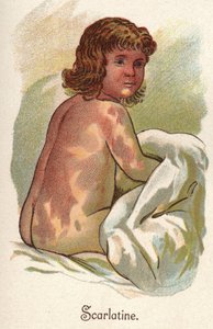 Kinderkrankheiten: Scharlach. In „The new natural medication“ von F.E. Bilz von Unknown artist