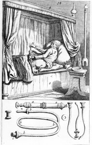 Klistier (für Einläufe) von Johannes Scultetus „Armamentarium Chirurgicum“. Venedig 1665 von Unknown artist