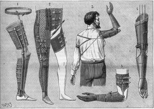 Moderne Apparate für Amputierte. 1) Künstliches Bein mit Gürtel, 2) Apparat für die Oberschenkelgelenke, 3 und 4 künstliche Arme, erfunden und gebaut von M.L Matthieu für den verstorbenen Roger, 5) künstlicher Arm mit Hand, Daumen und Zeigefinger. In „La n von Unknown artist