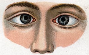 Konvergenter Strabismus. „The new natural medication“ von F.E. Bilz von Unknown artist