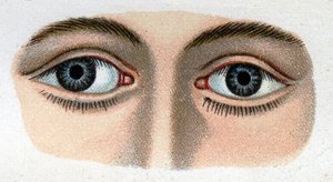 Divergenter Strabismus. „The new natural medication“ von F.E. Bilz