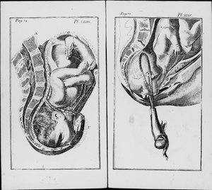 Geburt eines Babys mit Zangengeburt. Tafel aus „An abridgement of the practice of midwifery“ von William Smellie
