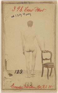 Bruch des oberen Drittels des Oberschenkelknochens. Erastus Worthen, Corp Co. B. 2. Vermont Vols. Alter 25 - Wohnort Stockbridge VT.