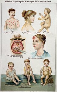 Tafel, die die verschiedenen Formen syphilitischer Krankheiten und die Gefahren der Impfung illustriert - in Bilz Naturheilkunde, Ende des 19. Jahrhunderts