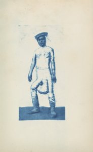 Elephantiasis, ca. 1870er Jahre (Foto) von Unknown photographer