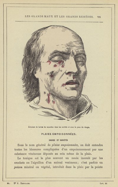 Schlüpfen von Fliegenlarven in den Höhlen und unter der Haut des Gesichts von French School