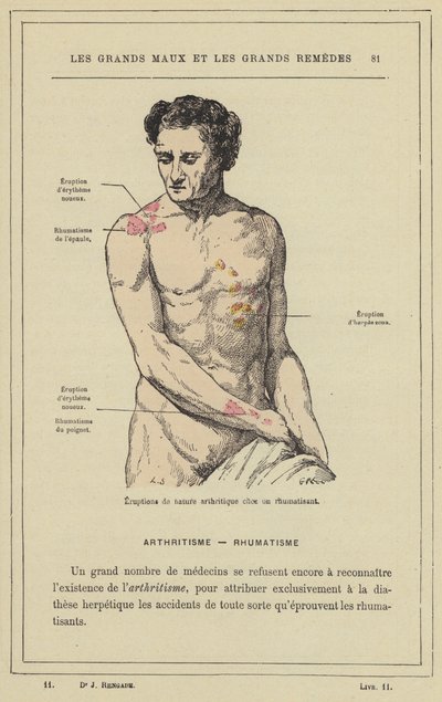 Arthritische Eruptionen bei einem Rheumatiker von French School