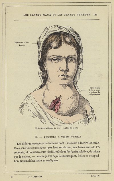 Septierter seröser Zyste am Hals, Lipom des Kopfes von French School