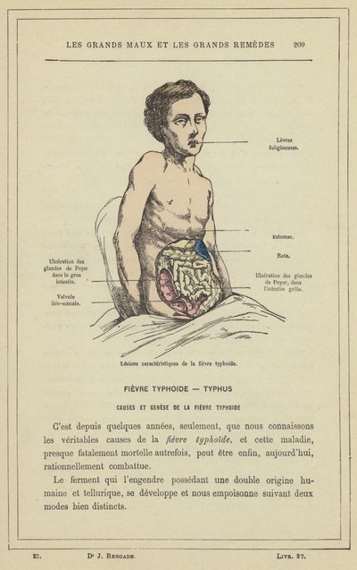 Charakteristische Läsionen des Typhus von French School