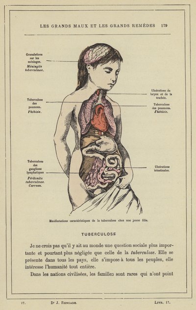 Charakteristische Manifestationen der Tuberkulose bei einem jungen Mädchen von French School