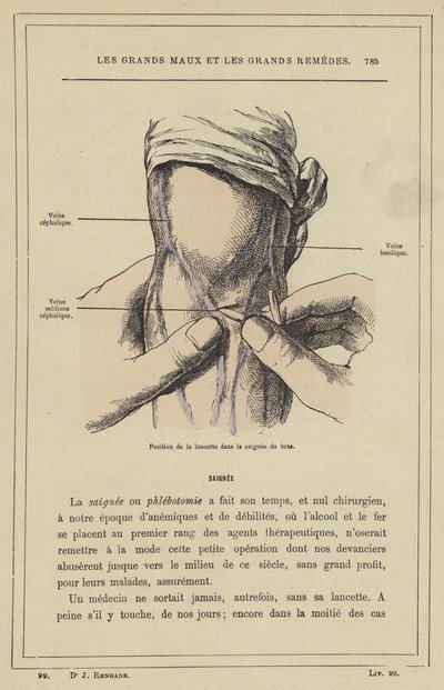 Position der Lanzette beim Aderlass am Arm von French School