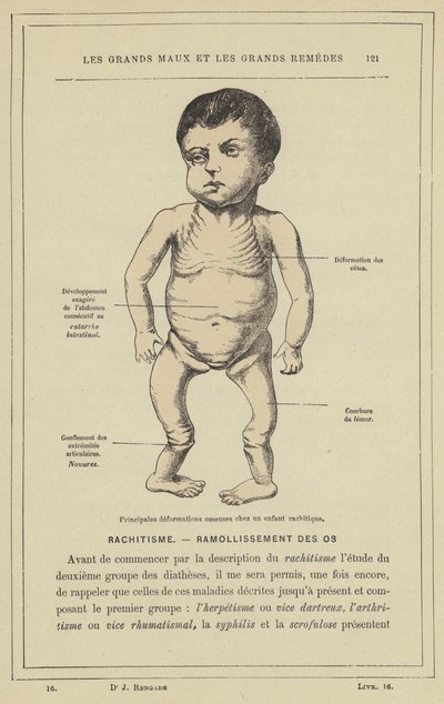 Hauptsächliche Knochendeformationen bei einem rachitischen Kind von French School