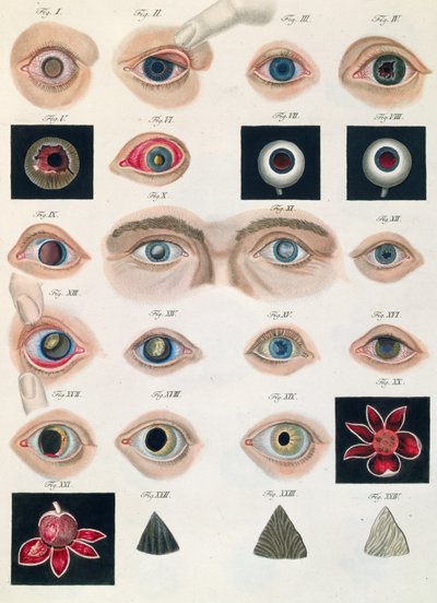 Beschreibung angeborener Augenanomalien, aus Klinische Darstellungen der Krankheiten und Bildungsfehler des menschlichen Auges, von Friedrich August von Ammon (1799-1861) 1838 von German School