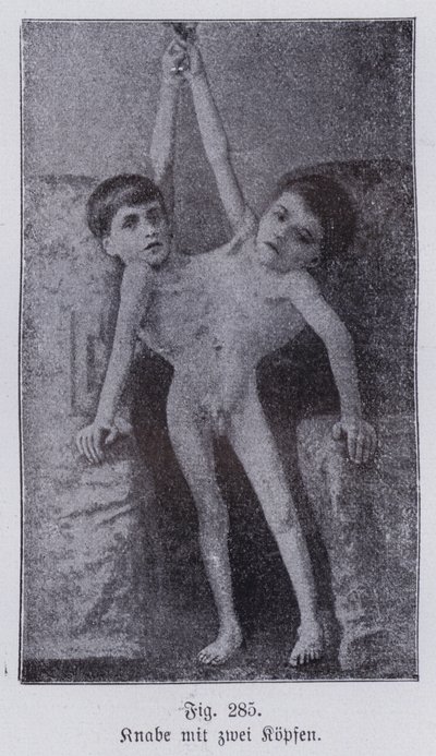 Giacomo und Giovanni Battista Tocci, italienische siamesische Zwillinge (s/w Foto) von Italian Photographer