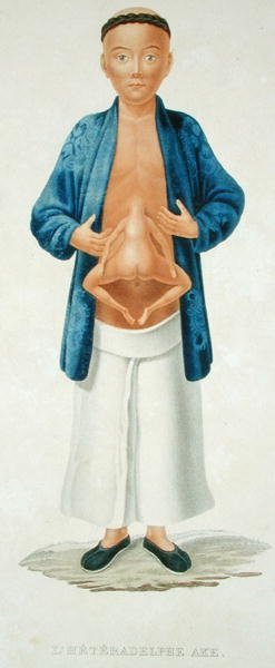 Chinesischer Mann mit einem unterentwickelten siamesischen Zwilling an seinem Bauch, Illustration aus einem französischen Reisebuch, graviert von M. Legrand (farbige Gravur) von Jean Gabriel (after) Pretre