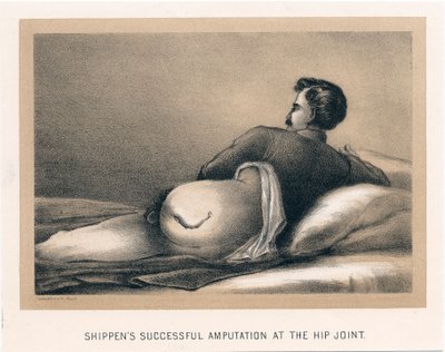 Shippens erfolgreiche Amputation am Hüftgelenk, Amerikanischer Bürgerkrieg, 1865 von Unbekannt