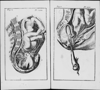 Geburt eines Babys mit Zangengeburt. Tafel aus „An abridgement of the practice of midwifery“ von William Smellie von Unknown artist