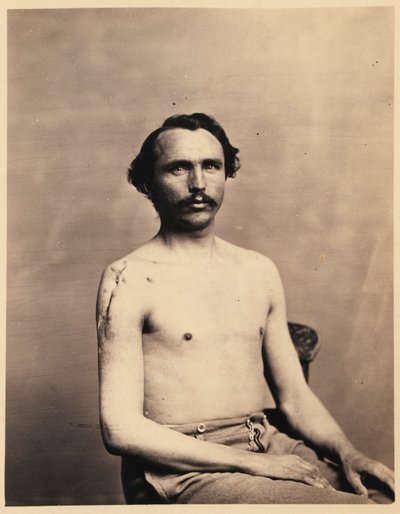 Private Adolph Zirsse, erfolgreicher Zwischenexzision des Kopfes und zweieinhalb Zoll des Schafts des rechten Humerus, aus dem fotografischen Katalog der chirurgischen Abteilung von William Bell