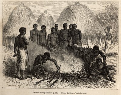 Chirurgische Methode zur Heilung von Knochenbrüchen, der Verletzte wird in ein Loch gesetzt, das Bein wird mit einem Blatt verbannt, dann wird die Grube mit Schlamm gefüllt und mit Knospen bedeckt, die sich entzünden und den Bruch erwärmen, der Patient wir von Edouard Riou