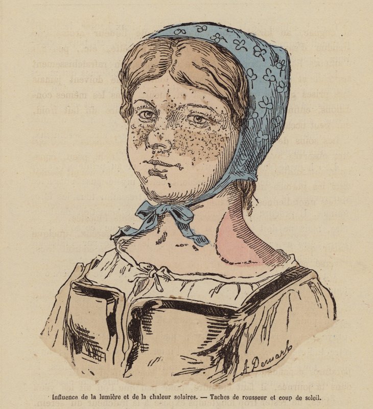 Frau mit Sommersprossen und Sonnenbrand durch übermäßige Sonneneinstrahlung von (after) French School