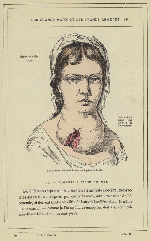 Septierter seröser Zyste am Hals, Lipom des Kopfes von French School