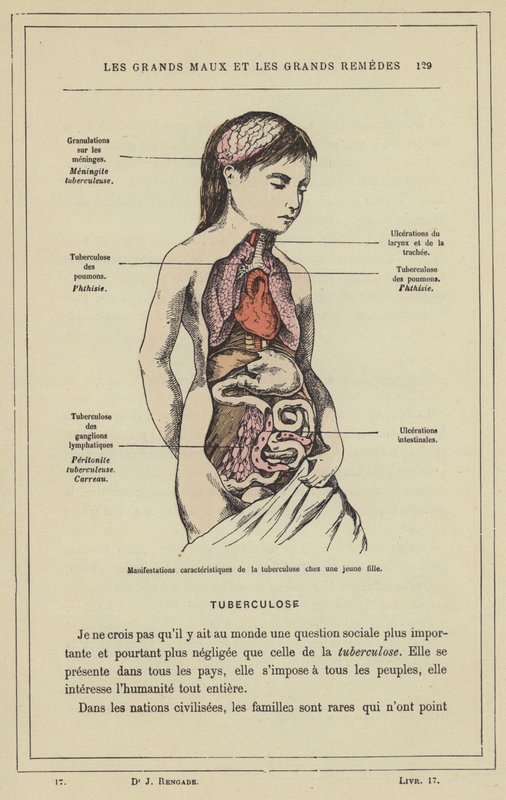 Charakteristische Manifestationen der Tuberkulose bei einem jungen Mädchen von French School