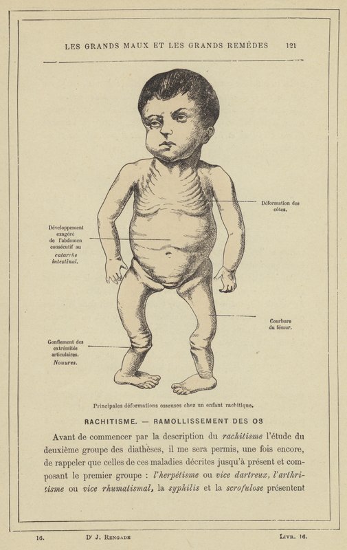 Hauptsächliche Knochendeformationen bei einem rachitischen Kind von French School