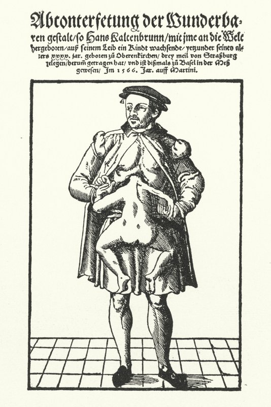 Hans Kaltenbrunn und sein unentwickelter siamesischer Zwilling von German School