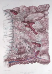 Krebs des Epiploons, aus 