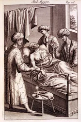Illustration der Moxibustion aus Medicina Aegyptorum von Prospero Alpinus, 1745