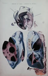 Herz- und Lungenapoplexie, Illustrationsplatte aus 