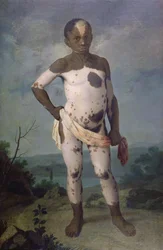 Kind mit Vitiligo, 1786