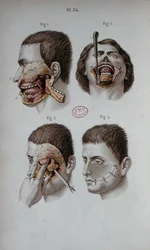 Anatomische Platte des Oberkiefers