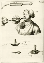 Verwendung einer Spritze zur Verabreichung eines Abführmittels, aus Exercitationes Practicae circa Medendi Methodum von Frederik Dekkers, 1694