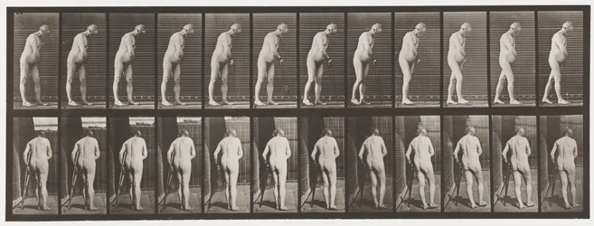Tafel 547. Hemiplegie; Gehen mit Krücke