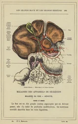 Gallensteine, Mechanismus der Gallenkolik