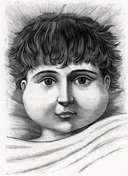 Kind mit Mumps (Gravur) 1888