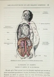 Auswirkungen von Diabetes, aus 