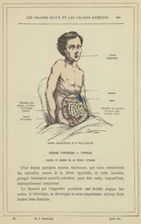 Charakteristische Läsionen des Typhus