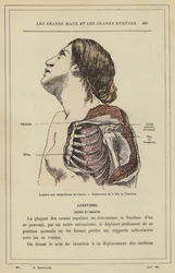Luxation unter dem Rabenschnabelfortsatz der Schulter, Verlagerung des Humeruskopfes