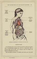 Charakteristische Manifestationen der Tuberkulose bei einem jungen Mädchen