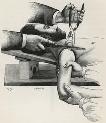 Resektion der Schulter, aus 