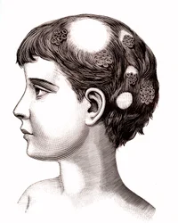 Ringelflechte bei einem Kind. 1887 (Gravur)