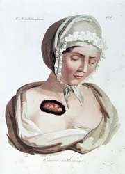 Anthrazin-Krebs - Alibert, B.N.