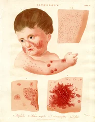 Pathologische Hautkrankheiten