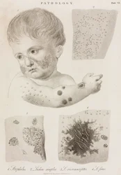 Dermatologie Arten von Hautkrankheiten